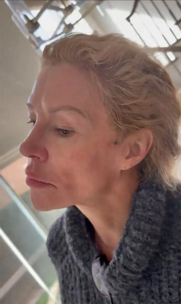 The rupture caused her to have silicone