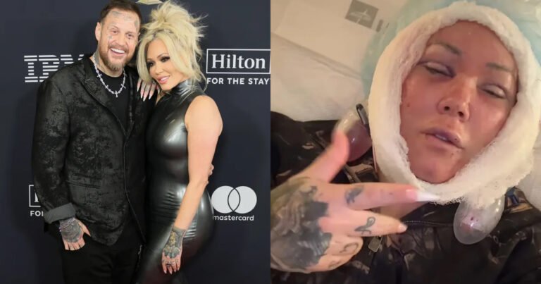 Bunnie Xo joked that she looked 'like Bert Kreischer' after getting her facelift